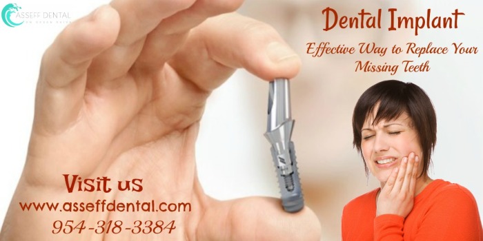 Dental Implants - Effective way to replace your missing teeth